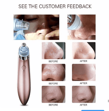 Blackheads Remover Vacuum Suction, Blackhead Removal Machine,  Deeply Facial Cleaning Tool